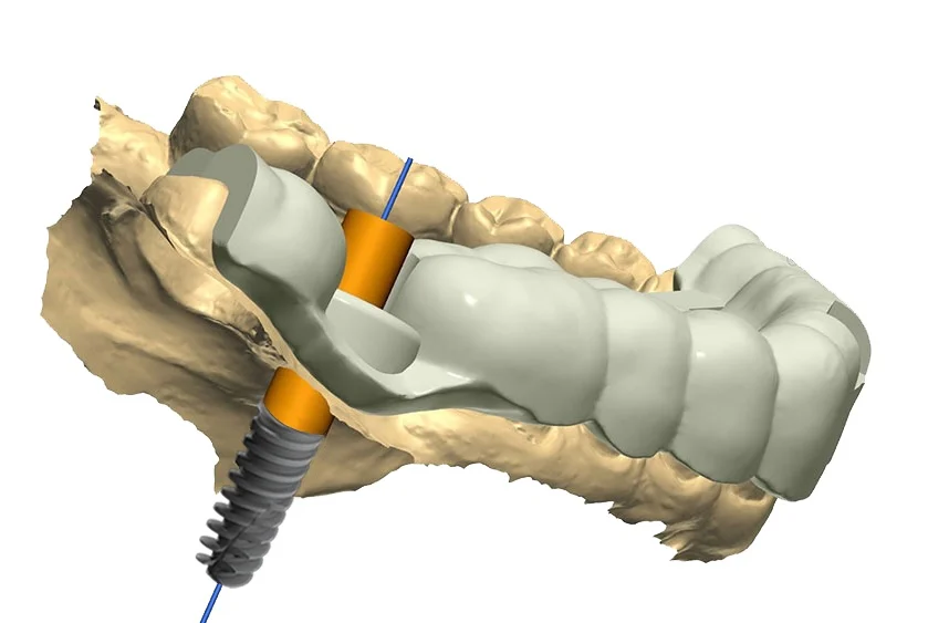 Surgical Guide İmplant Klavuz İmplant, Cerrahi Rehber İle İmplant