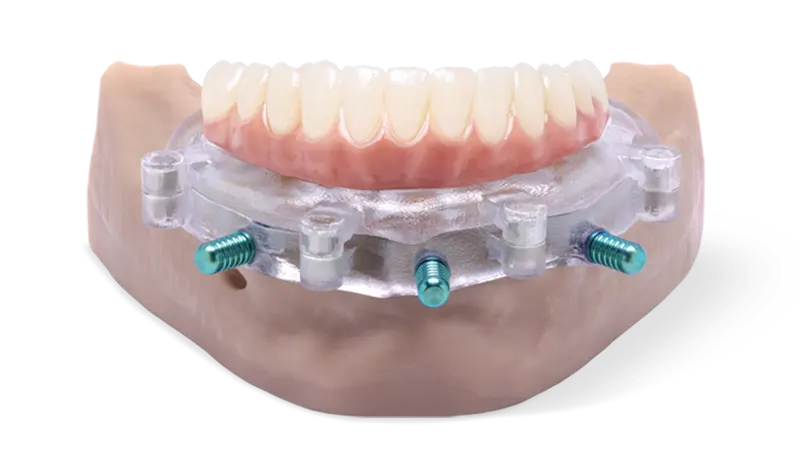 Surgical Guide İmplant Klavuz İmplant, Cerrahi Rehber İle İmplant
